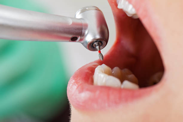 Best Emergency Dental Care for Broken or Chipped Teeth in New Plymouth, ID